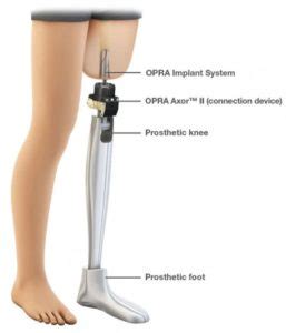 Positive Osseointegration: Enhancing Blood Transfusion Outcomes for Patients